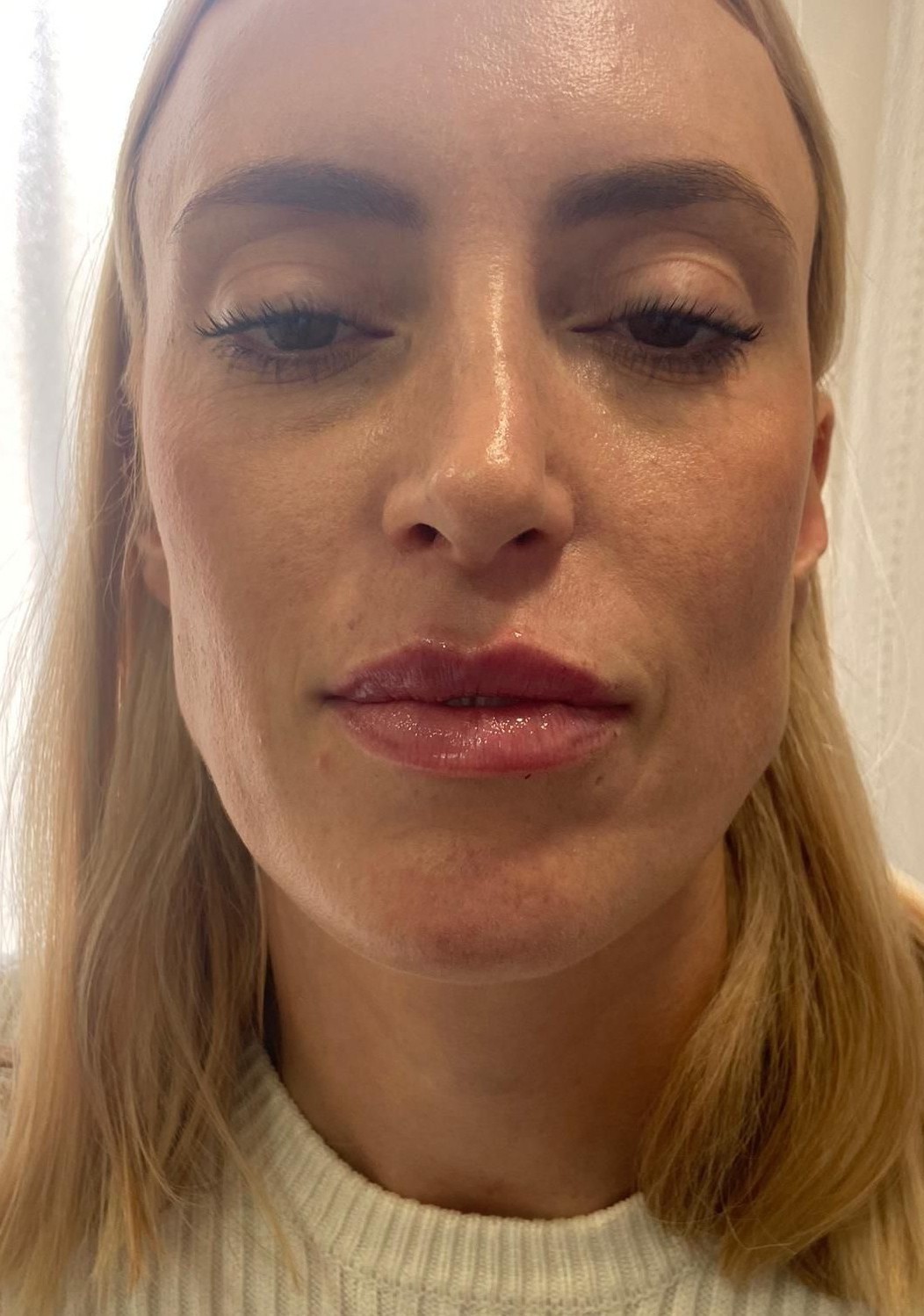 Resultado Labios