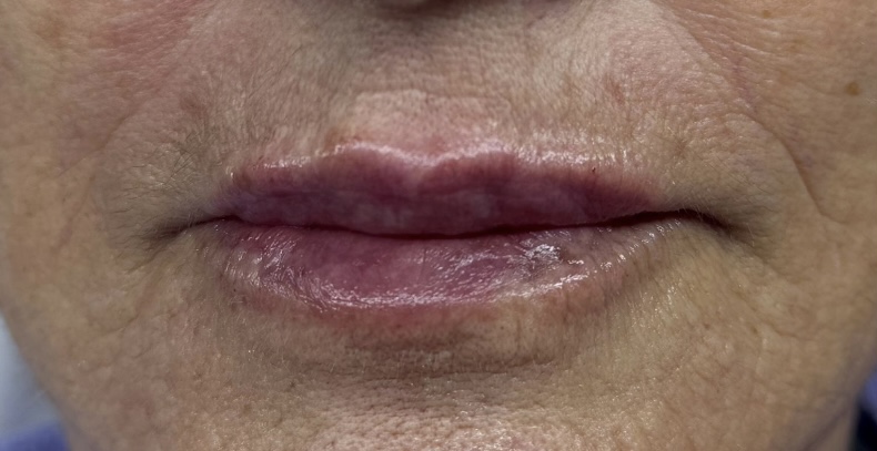 Resultado Labios