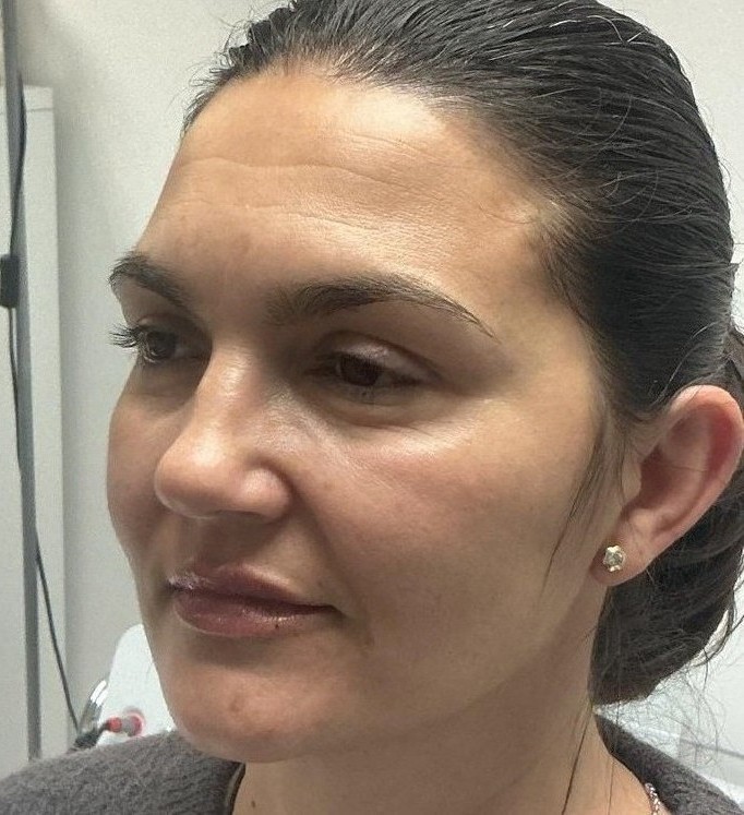 Retoque Labial