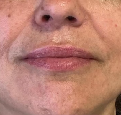 Resultado Labios